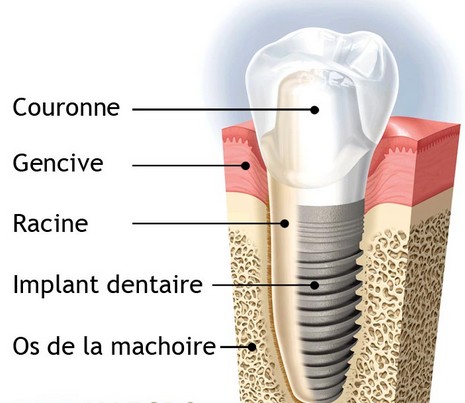 implant dentaire structure